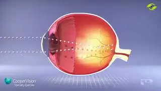 Discover Ortho-K Lenses at Premier Eyecare | Overnight Vision Correction in Barnsley & Sheffield