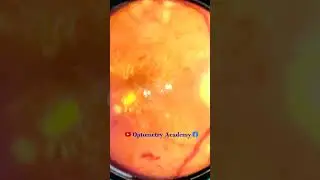 Diabetic retinopathy | Hemorrhages | cotton wool spots | Hard exudates | Fundus | Short Video 128