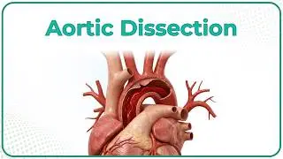 Aortic Dissection : Etiology, Pathogenesis, Clinical features and Management