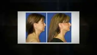 Facelift NYC - Face Lift Plastic Surgeon New York