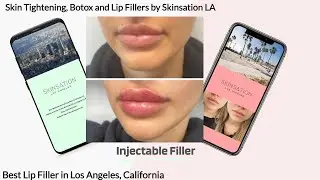 Skin Tightening, Botox and Lip Fillers by Skinsation LA - Medical spa in Los Angeles CA