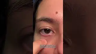 #Blepharoplasty #LowerBleph #NYCPlasticSurgery #NYCPlasticSurgeon #PlasticSurgery #PlasticSurgeon
