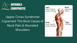 Neck Posture Explained! What is Upper Cross Syndrome? Learn more today.