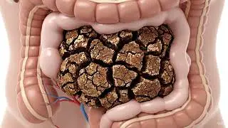 What REALLY Happens Inside Your Colon During Constipation (3D Visual) How To Increase Gut Health