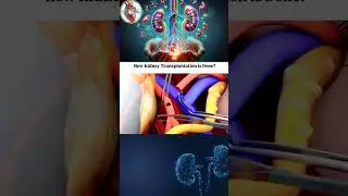 Kidney Transplant 😷. #kidney #mbbs