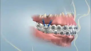 Boston Oral Surgeon. Temporary Orthodontic Anchorage at Lucca oral and Facial Surgery Back Bay
