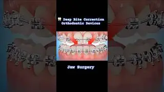 Deep Bite Correction by Braces + Jaw Surgery