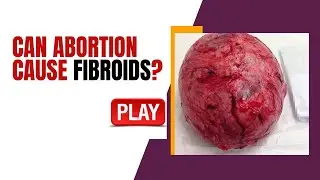 Can Abortion Cause Fibroids? | Explained