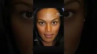 Facial Feminization Surgery