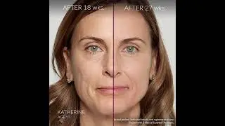 Sculptra&reg; | A Poly-L-lactic Acid Facial Injection