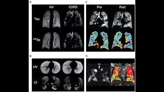 Ultrasound, Computed tomography, Magnetic Resonance Imaging Scan in Diagnosing Respiratory System