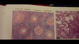 #cns tumor #pathology #mbbs2ndyear #mbbspathology #cns #cns #tumors of cns