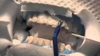 In-Office Tooth-Whitening