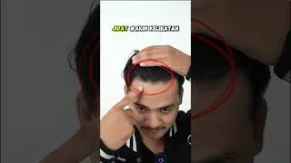 SPILL RAHASIA CARA NGILANGIN PITAK, RAMBUT RONTOK, DAN KEBOTAKAN CUMA PAKAI INI #madevine