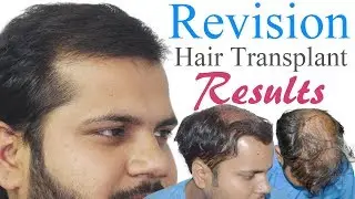 Full Revision Hair Transplant Video Facts & Fiction Information by Dr Suneet Soni | MediSpa INDIA