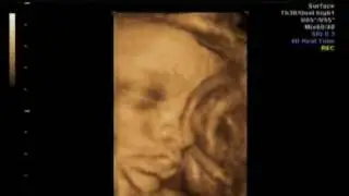 3d echo van ons ventje; 33 weken