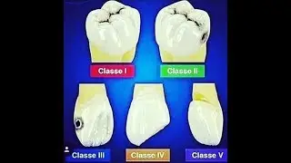 Classification of dental caries