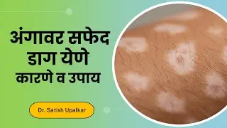 अंगावर सफेद डाग येणे यावरील उपाय : Dr Satish Upalkar | Angavar safed daag upay in Marathi