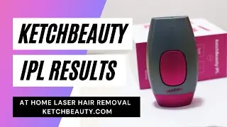 [KetchBeauty] IPL At Home Laser Hair Removal Handset Results and Reviews