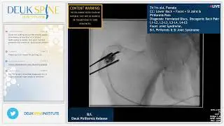 Minimally Invasive Deuk Piriformis Muscle Release for Lower Back Pain from Piriformis Syndrome