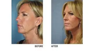 Boca Raton Facelift Surgeon | Botox Procedure | LIV Plastic Surgery | Dr. Andrew Ress