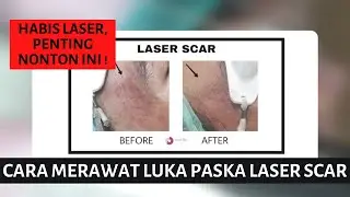 Hilangkan Bopeng Jerawat dengan Erbium Laser - TIPS Paska Laser Bopeng Bekas Jerawat - Ovela Clinic