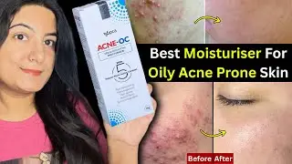 Acne Oc Moisturizer For Oily/Acne Prone Skin || Non comedogenic moisturizer || Simran Skincare