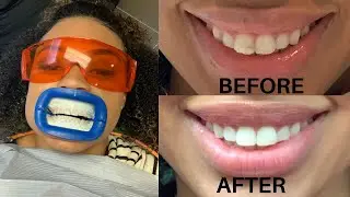 GETTING MY TEETH FIXED! No Veneers | Icon & bonding treatment