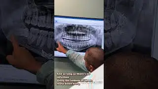 Westside Dental Center - Wisdom Teeth Extraction For Older Patients - Plantation, FL