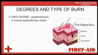first degree burn, whta is first degree burn, first aid care in first degree burn