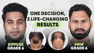 Hair Transplant in India (HX-CFSQ) | Best Results & Cost of Hair Transplant in India.