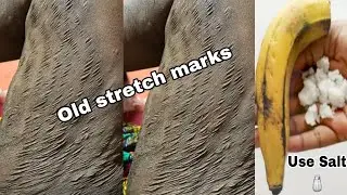 Get Rid Of Stretch Marks Super Fast and Permanently, Have a Nourished Smooth Soft Body using 🧂 & 🍌