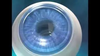 step2 Intralase