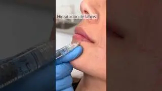 Hidrataci&oacute;n de Labios con &Aacute;cido Hialur&oacute;nico
