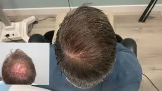 Crown Hair restoration with 2500 grafts FUE