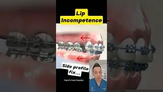 Can Braces Solve Lip Incompetence? How It Achieves Lip Closure #dentallan #dentist #shorts