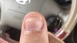 How my smashed thumb nail fingernail looks today