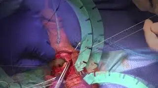 Penile Implant Remove and Replace by Dr  Andrew Kramer