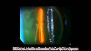 Classification of posterior vitreous detachment ID 54021 Supplementary video 3