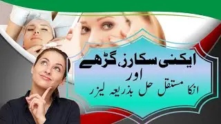 Major Dr Shaffan Musaddiq | CO2 Fractional Laser Procedure For Acne Spots | Malik Arif Awan