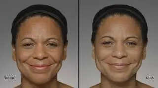 Restylane Refyne Before & After | Restylane in Indianapolis