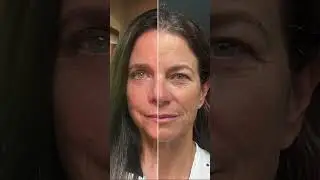 Upper Blepharoplasty + Rhinoplasty Results by Dr. Shashi Kusuma | Suria Cosmetic Surgery Weston, FL