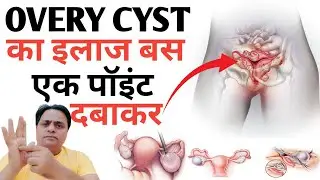 Acupressure Points For Ovary Cyst। Acupressure For Pcos Problem। Ovarian Cyst Removal Home Remedies