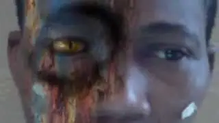 burned face