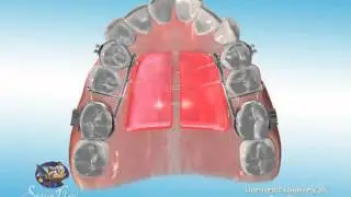 DynaFlex DMAX 2000