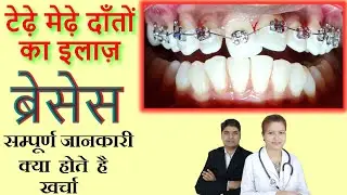 BRACES । Complete information for INDIA । ब्रेसेस के बारे में सम्पूर्ण बातें हिंदी में ।