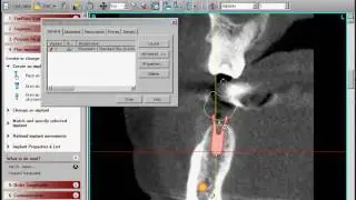 Implant Placement Planning using 3D Digital Imaging Techniques