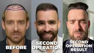 HAIR TRANSPLANT IN TWO SESSIONS / DR FIRDAVS AHMEDOV EXPLAINS WITH CASE ANALYZE