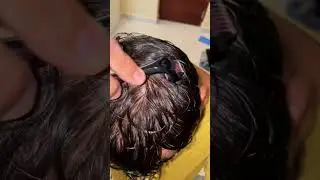 Day 4 Derma Roller - Onion Juice For Hair Growth Before And After #Shorts