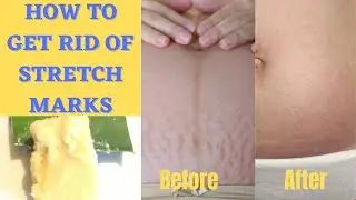 How To Get Rid Of Stretch Marks With Alovera/Shea butter/DIY